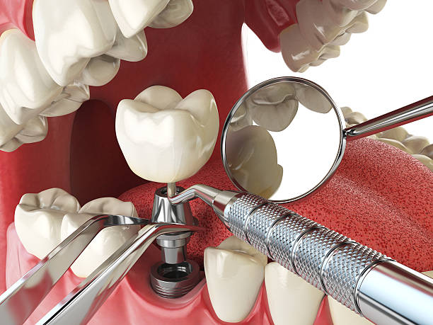 Best Lost Filling or Crown Replacement in Plymouth, MN