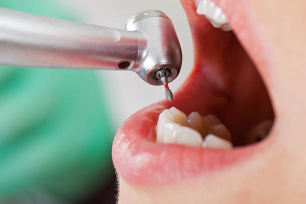 Best Broken or Chipped Tooth Repair in Plymouth, MN